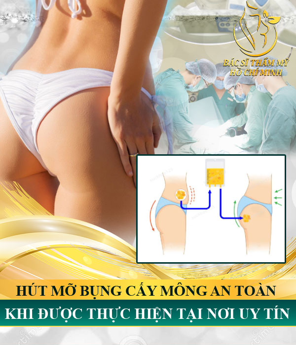 Hút mỡ bụng cấy mông an toàn khi được thực hiện tại nơi uy tín | Cấy mỡ mông: Bí quyết vòng 3 mềm mại, căng tròn tự nhiên
